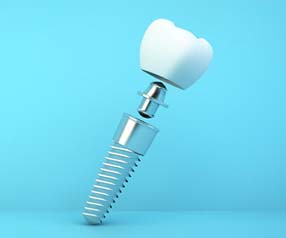 Dental implant in Tyler