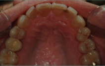 Inside of bottom teeth before dental restoration