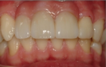 Smile after teeth are replaced