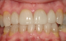 Smile after damaged top tooth is repaired