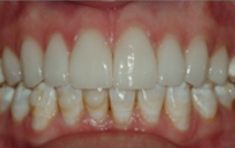 Closed gap between top and bottom teeth