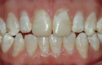 Gap between top and bottom teeth
