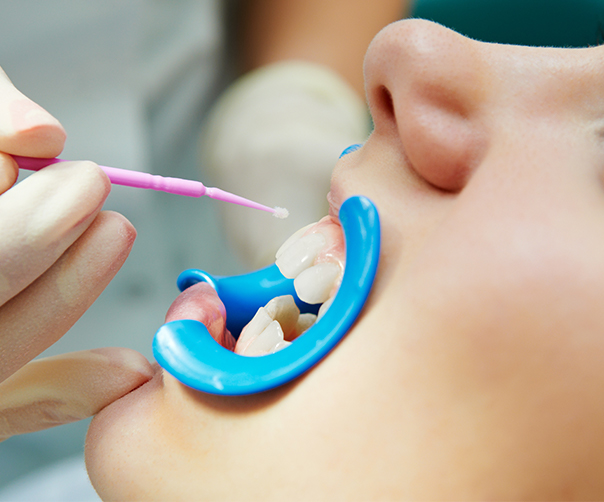 Child receiving fluoride treatment