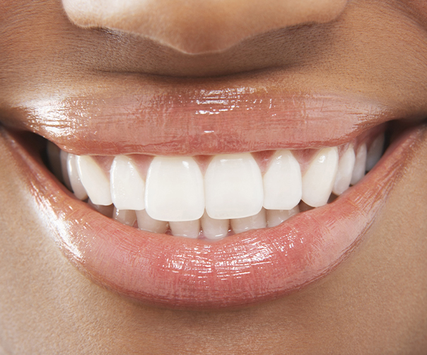 Closeup of smile after gum recontouring