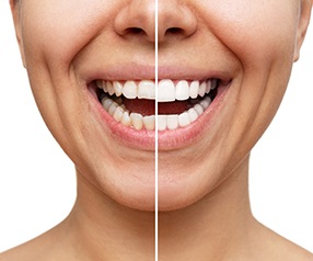 Before and after veneers