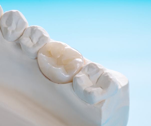 Dental crown on model of teeth