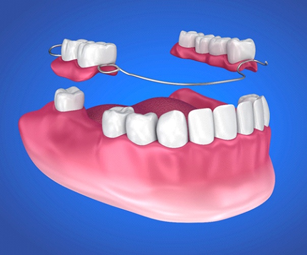 Model of a partial denture.