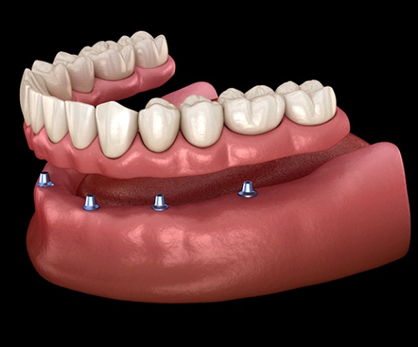 Model of an implant denture.