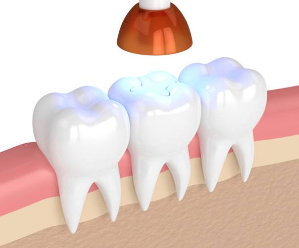 Dental light hardening composite filling