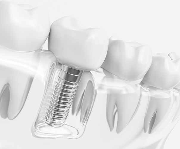 Animated smile with dental implant supported dental crown