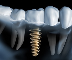 X-ray of a patient with a dental implant 