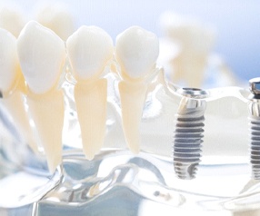Dental model of implant posts