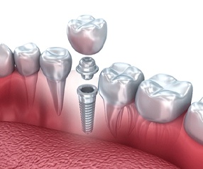 Each part of a single dental implant