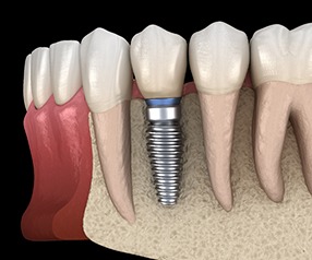 Diagram of an integrated dental implant in Tyler