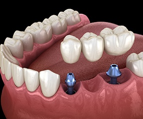 Diagram of a bridge hovering over dental implants in Tyler