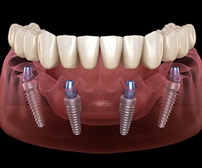 Diagram showing implant denture and four dental implants in Tyler
