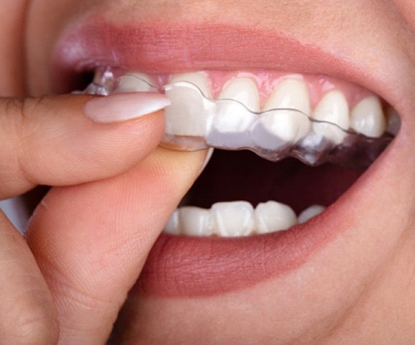 close up of a person putting clear aligner into their mouth
