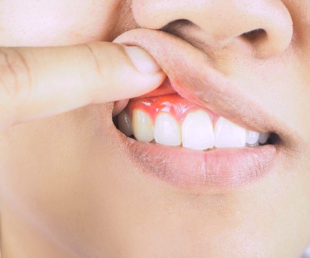 Closeup of woman with gum disease