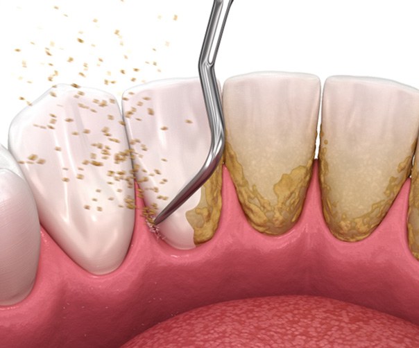 Digital illustration of scaling and root planing