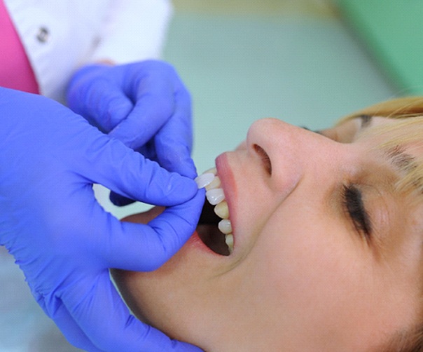 Dentist placing veneer against patient's tooth