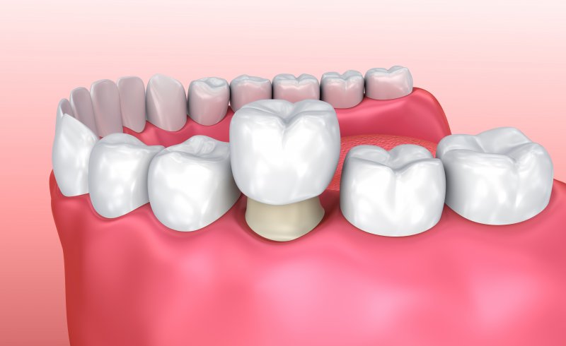 3-D model of a dental crown