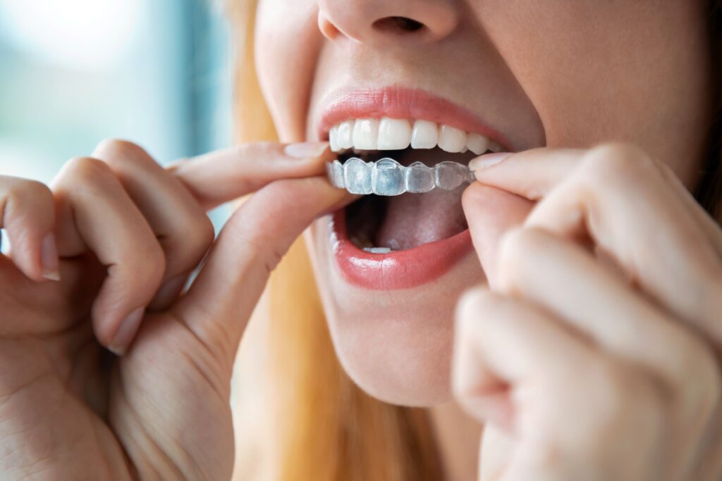 Nose-to-chin view of woman putting Invisalign over upper arch