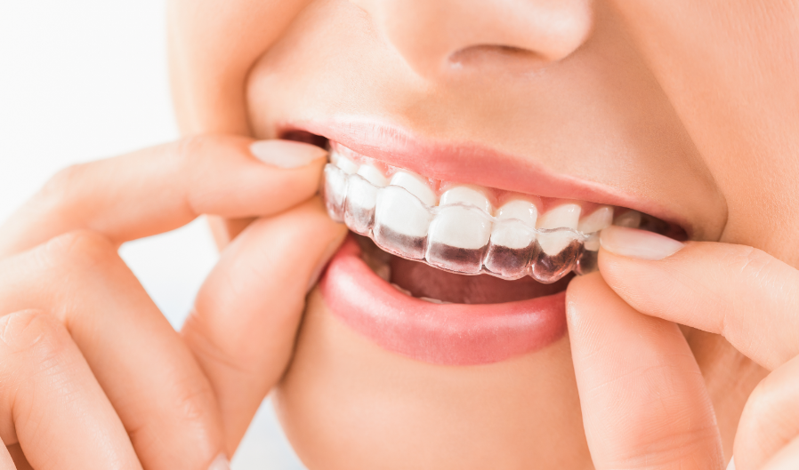 Woman putting on clear aligner
