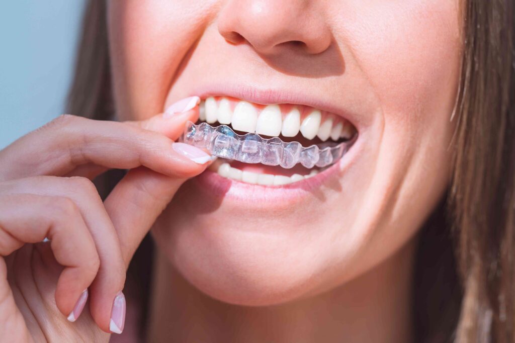 Closeup of a woman putting in clear aligners